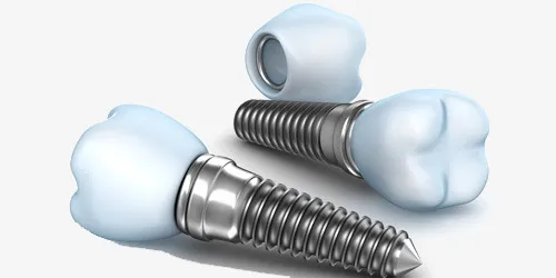 IMPLANTOLOGÍA: Implantes Dentales Fuengirola